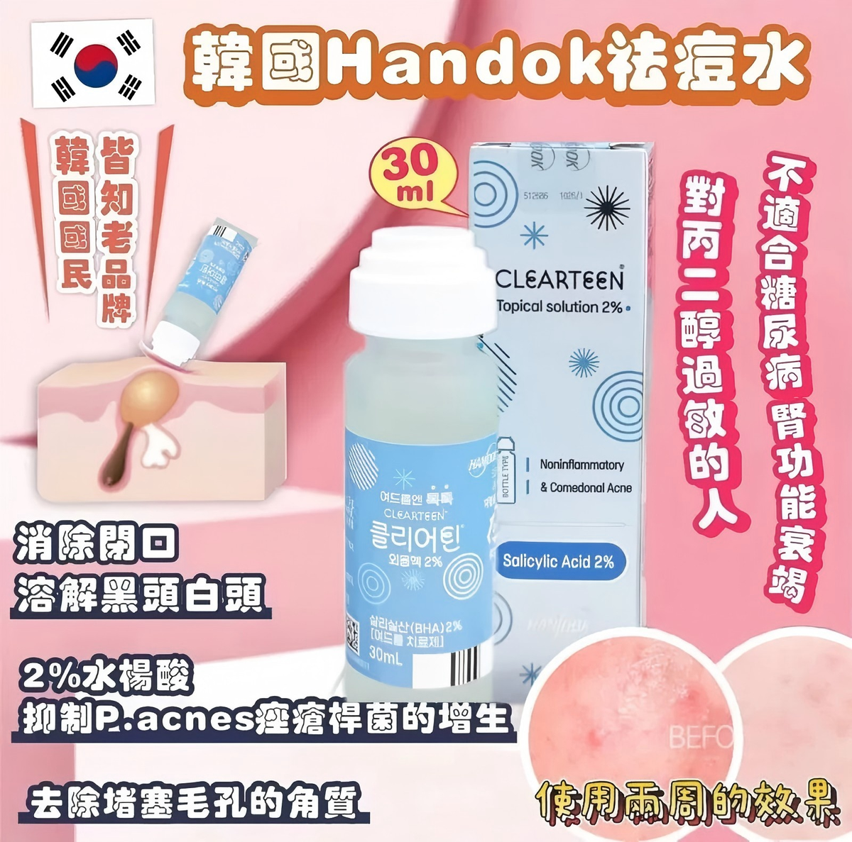 HANDOK - HANDOK 水楊酸祛痘抗粉刺抗痘水  30ml 平行进口